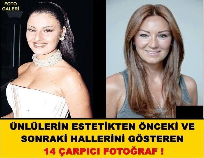 Ünlülerin Estetikten Önceki Ve Sonraki Hallerini Gösteren 14 Çarpıcı Fot galerisi resim 1