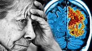 Alzheimer hastalığının ilk belirtisi galerisi resim 3