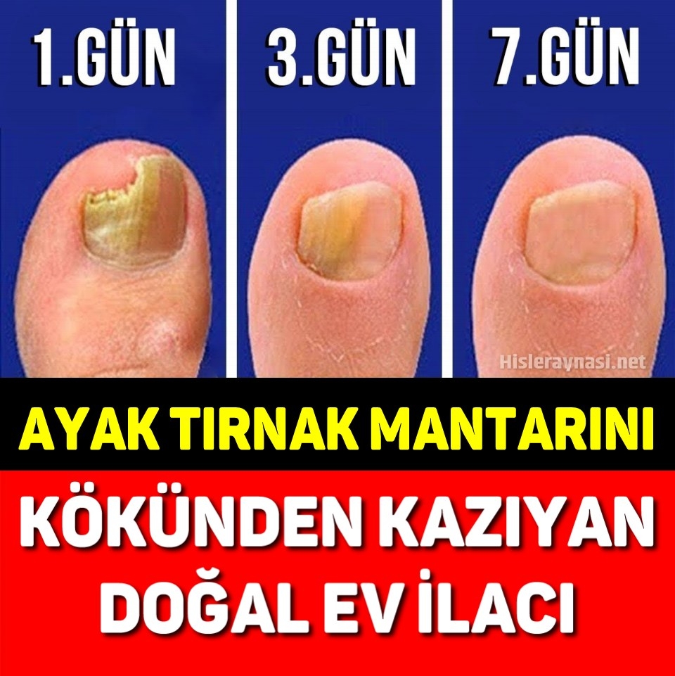 Ayak Mantarından Kurtulmanın Pratik Tarifi galerisi resim 1