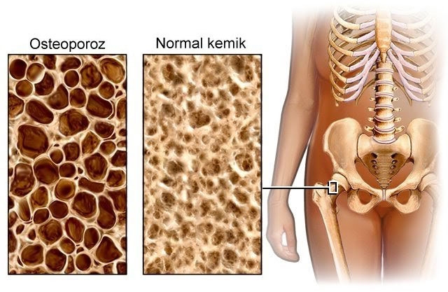 Kemik erimesini önlemek için galerisi resim 2