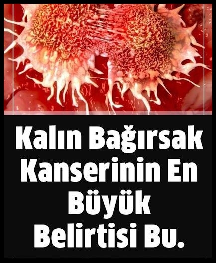 Kalın bağırsak kanseri nasıl anlaşılır galerisi resim 1