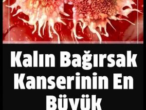 Kalın bağırsak kanseri nasıl anlaşılır