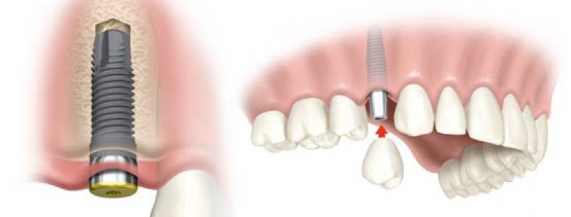 Çenesi eriyen hasta şikayet etti, sahte implant çetesi yakalandı galerisi resim 3