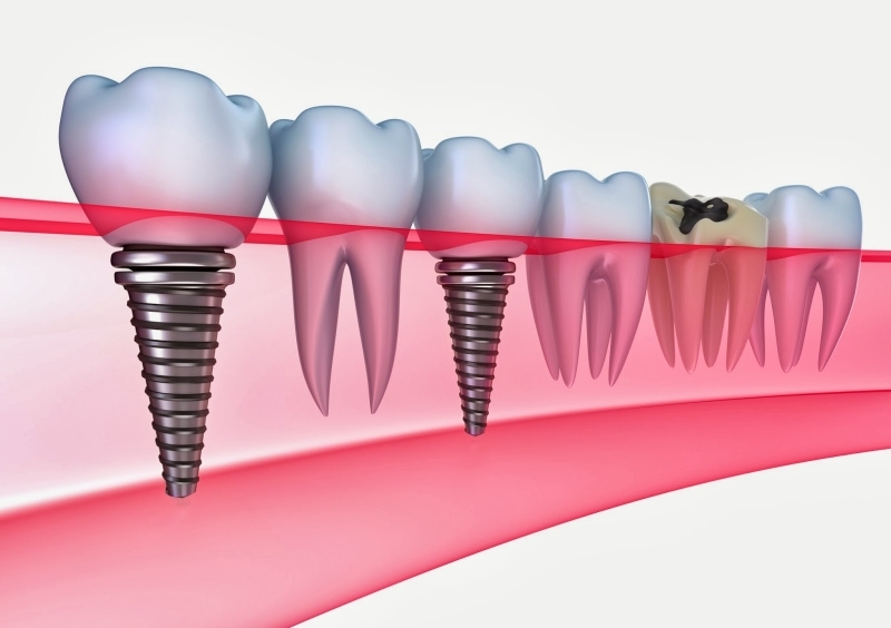 Çenesi eriyen hasta şikayet etti, sahte implant çetesi yakalandı galerisi resim 5