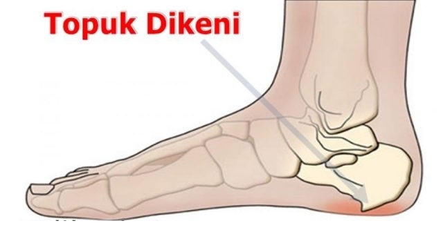 TOPUK DİKENİ SORUNUNDAN DOĞAL YOLLARLA KURTULMAK MÜMKÜN! ÜSTELİK SADECE galerisi resim 3