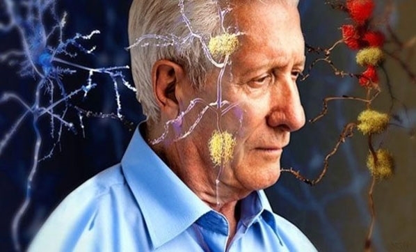 Alzheimer’ı Önlemek İçin Tavsiye ve Yapılması Gerekenler galerisi resim 3