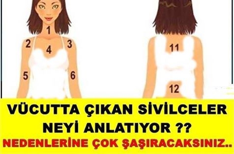 Hani kurtulamadığımız o sivilceler var ya bakın neden çıkıyormuş! galerisi resim 6