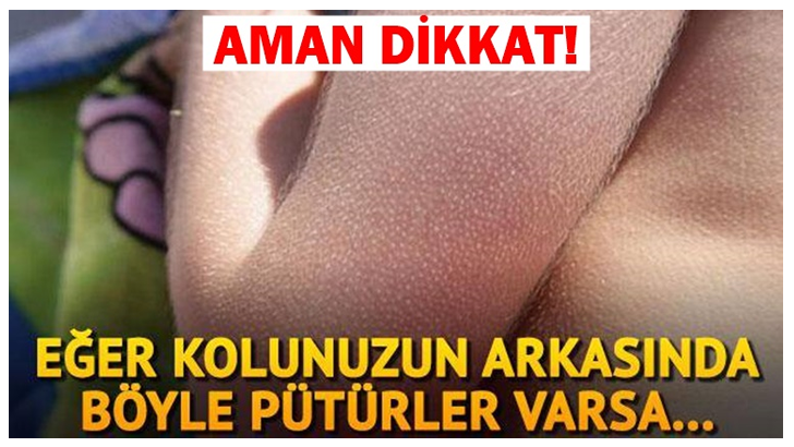 DİKKAT! EĞER VÜCUDUNUZDA BÖYLE PÜTÜRLER VARSA.