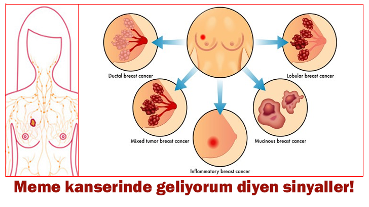 Aman göz ardı etmeyin Meme kanseri geliyorum diyor