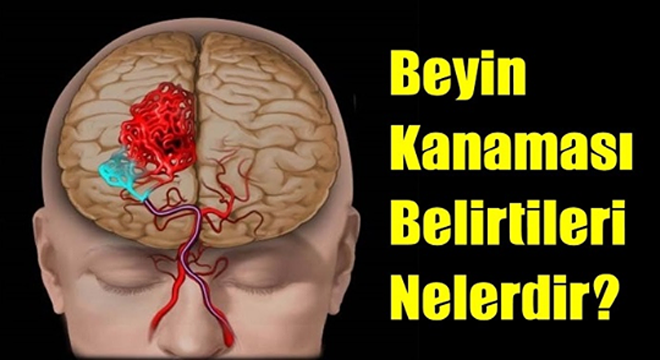 Bir kişinin beyin k-anaması geçirdiğini şu dört basit yöntemle anlayabilirsiniz