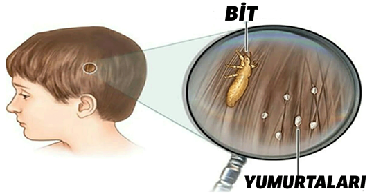 Bu Yöntemi Çok Az Doktor Biliyor, Bitten Kurtulmanın En Hızlı, Ucuz Ve Kolay Yolu